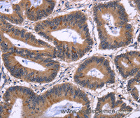 Immunohistochemistry of paraffin-embedded Human colon cancer tissue using NFATC3 Polyclonal Antibody at dilution 1:60