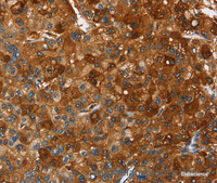 Immunohistochemistry of paraffin-embedded Human liver cancer using PAK2 Polyclonal Antibody at dilution of 1:40