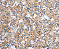 Immunohistochemistry of paraffin-embedded Human thyroid cancer using PAK2 Polyclonal Antibody at dilution of 1:40