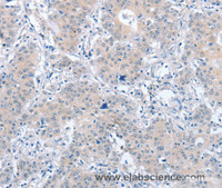 Immunohistochemistry of paraffin-embedded Human gasrtic cancer tissue using PARD6A Polyclonal Antibody at dilution 1:60