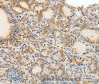 Immunohistochemistry of paraffin-embedded Human thyroid cancer tissue using Otocadherin Polyclonal Antibody at dilution 1:60