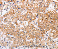 Immunohistochemistry of paraffin-embedded Human lung cancer tissue using PPP1CB Polyclonal Antibody at dilution 1:40