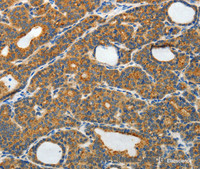 Immunohistochemistry of paraffin-embedded Human thyroid cancer tissue using RAMP3 Polyclonal Antibody at dilution 1:40