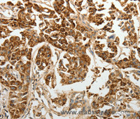 Immunohistochemistry of paraffin-embedded Human lung cancer using E-Selectin Polyclonal Antibody at dilution of 1:30