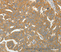 Immunohistochemistry of paraffin-embedded Human ovarian cancer using RPLP0 Polyclonal Antibody at dilution of 1:40