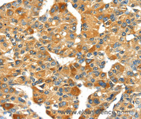 Immunohistochemistry of paraffin-embedded Human liver cancer using SPARC Polyclonal Antibody at dilution of 1:35