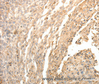Immunohistochemistry of paraffin-embedded Human cervical cancer tissue using SFTPD Polyclonal Antibody at dilution 1:30