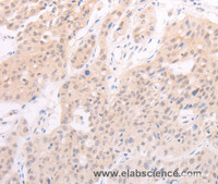 Immunohistochemistry of paraffin-embedded Human lung cancer using F7 Polyclonal Antibody at dilution of 1:40