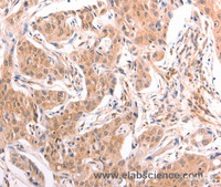Immunohistochemistry of paraffin-embedded Human lung cancer tissue using TNF beta Polyclonal Antibody at dilution 1:50