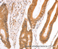 Immunohistochemistry of paraffin-embedded Human colon cancer tissue using TAX1BP1 Polyclonal Antibody at dilution 1:40