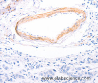 Immunohistochemistry of paraffin-embedded Human breast cancer using TPM1 Polyclonal Antibody at dilution of 1:80