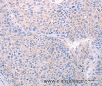 Immunohistochemistry of paraffin-embedded Human liver cancer using SPATA6 Polyclonal Antibody at dilution of 1:40