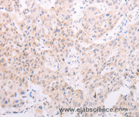 Immunohistochemistry of paraffin-embedded Human lung cancer using TYR Polyclonal Antibody at dilution of 1:30