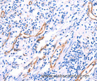 Immunohistochemistry of paraffin-embedded Human gasrtic cancer tissue using VWF Polyclonal Antibody at dilution 1:50