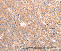 Immunohistochemistry of paraffin-embedded Human liver cancer tissue using ABCF1 Polyclonal Antibody at dilution 1:40