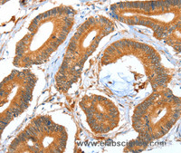 Immunohistochemistry of paraffin-embedded Human colon cancer using ACOT11 Polyclonal Antibody at dilution of 1:40