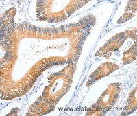 Immunohistochemistry of paraffin-embedded Human colon cancer using ACY3 Polyclonal Antibody at dilution of 1:35