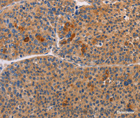 Immunohistochemistry of paraffin-embedded Human liver cancer using ALDH3A1 Polyclonal Antibody at dilution of 1:55