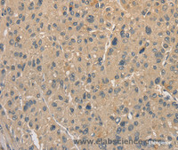 Immunohistochemistry of paraffin-embedded Human liver cancer using ALDH8A1 Polyclonal Antibody at dilution of 1:40