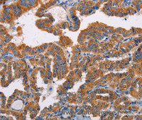 Immunohistochemistry of paraffin-embedded Human thyroid cancer tissue using ALG9 Polyclonal Antibody at dilution 1:30