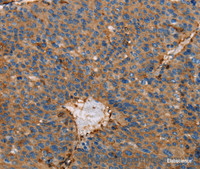 Immunohistochemistry of paraffin-embedded Human liver cancer using ACTA1 Polyclonal Antibody at dilution of 1:65