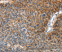 Immunohistochemistry of paraffin-embedded Human liver cancer using AMDHD2 Polyclonal Antibody at dilution of 1:40