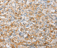 Immunohistochemistry of paraffin-embedded Human thyroid cancer using APOBEC3G Polyclonal Antibody at dilution of 1:30