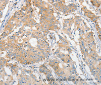 Immunohistochemistry of paraffin-embedded Human gastric cancer using APOBEC3G Polyclonal Antibody at dilution of 1:30