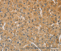 Immunohistochemistry of paraffin-embedded Human liver cancer tissue using AMZ2 Polyclonal Antibody at dilution 1:60