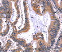 Immunohistochemistry of paraffin-embedded Human colon cancer using ARC Polyclonal Antibody at dilution of 1:50