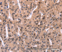 Immunohistochemistry of paraffin-embedded Human liver cancer using ARC Polyclonal Antibody at dilution of 1:50