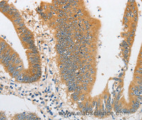 Immunohistochemistry of paraffin-embedded Human colon cancer tissue using ARHGAP5 Polyclonal Antibody at dilution 1:30