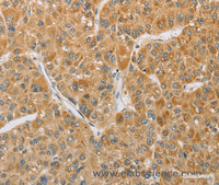 Immunohistochemistry of paraffin-embedded Human liver cancer tissue using ARHGEF1 Polyclonal Antibody at dilution 1:60