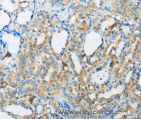 Immunohistochemistry of paraffin-embedded Human thyroid cancer tissue using ARSA Polyclonal Antibody at dilution 1:50