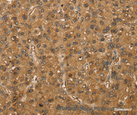 Immunohistochemistry of paraffin-embedded Human liver cancer tissue using SETD2 Polyclonal Antibody at dilution 1:30