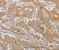 Immunohistochemistry of paraffin-embedded Human gasrtic cancer tissue using ARSK Polyclonal Antibody at dilution 1:30