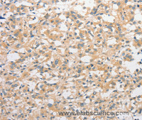 Immunohistochemistry of paraffin-embedded Human thyroid cancer tissue using CD284 Polyclonal Antibody at dilution 1:50