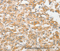 Immunohistochemistry of paraffin-embedded Human thyroid cancer tissue using TLR5 Polyclonal Antibody at dilution 1:30