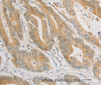 Immunohistochemistry of paraffin-embedded Human colon cancer tissue using ZWINT Polyclonal Antibody at dilution 1:50