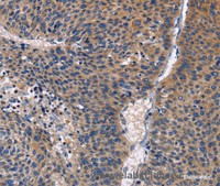 Immunohistochemistry of paraffin-embedded Human liver cancer using PKC delta Polyclonal Antibody at dilution of 1:30