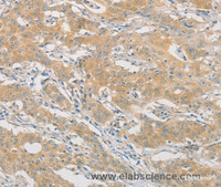 Immunohistochemistry of paraffin-embedded Human gasrtic cancer tissue using HIPK4 Polyclonal Antibody at dilution 1:30