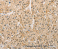 Immunohistochemistry of paraffin-embedded Human liver cancer using PGK2 Polyclonal Antibody at dilution of 1:50