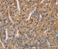 Immunohistochemistry of paraffin-embedded Human liver cancer tissue using RICTOR Polyclonal Antibody at dilution 1:40