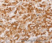 Immunohistochemistry of paraffin-embedded Human thyroid cancer using AK2 Polyclonal Antibody at dilution of 1:30