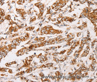 Immunohistochemistry of paraffin-embedded Human breast cancer using AK2 Polyclonal Antibody at dilution of 1:30