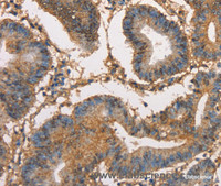 Immunohistochemistry of paraffin-embedded Human colon cancer tissue using HK3 Polyclonal Antibody at dilution 1:40