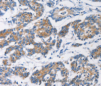 Immunohistochemistry of paraffin-embedded Human colon cancer tissue using HK1 Polyclonal Antibody at dilution 1:50