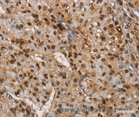 Immunohistochemistry of paraffin-embedded Human liver cancer tissue using TSPEAR Polyclonal Antibody at dilution 1:50