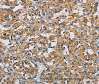 Immunohistochemistry of paraffin-embedded Human thyroid cancer using GPM6A Polyclonal Antibody at dilution of 1:50