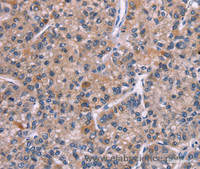 Immunohistochemistry of paraffin-embedded Human liver cancer tissue using PIP5K1B Polyclonal Antibody at dilution 1:30